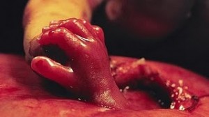 cirugia.fetal.espina.bífida