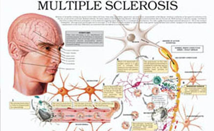 esclerosis-multiple