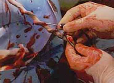Células madre del cordón umbilical y tratamiento de enfermedades congénitas