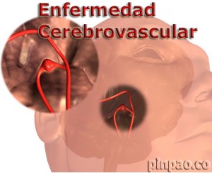 Enfermedad cerebrovascular concepto diagnostico y clasificación