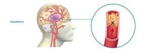 Accidenete cerebrovascular isquémico y hemorrágico