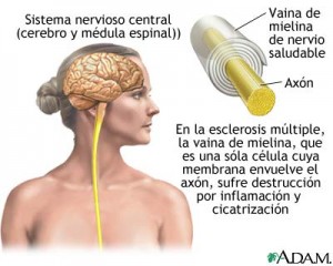 Esclerosis Multiple consejos de alimentación 