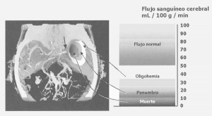 ACV inquemico y ACV recurrente