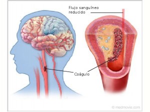 Ataque Cerebrovascular Isquémico del Adulto 
