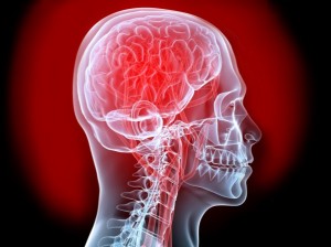 Ataque Cerebrovascular aspectos generales