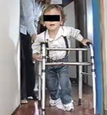 Ayudas para la marcha en la parálisis cerebral infantil