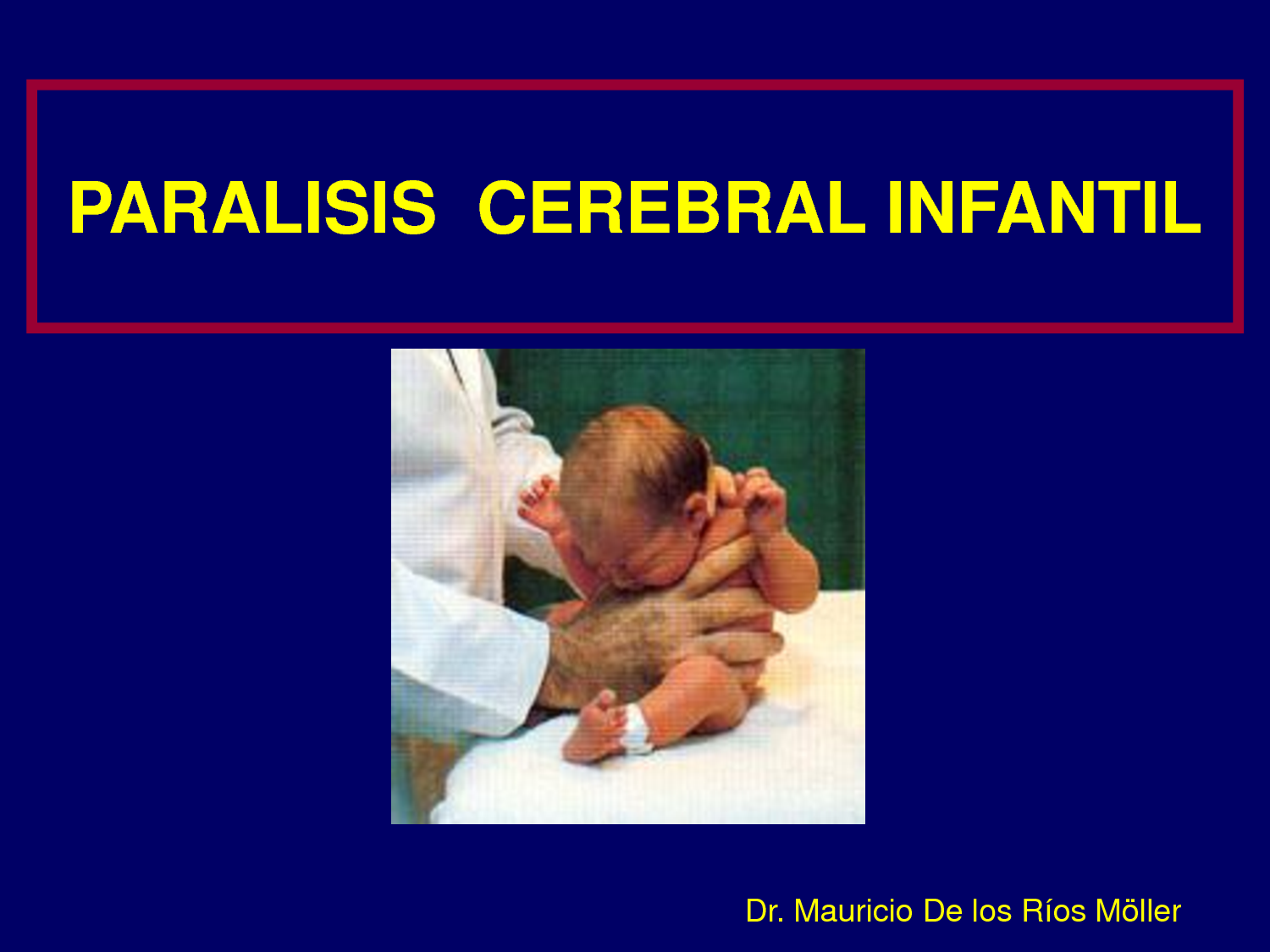 PCI Paralisis cerebral infantil tipos causas y tratamientos