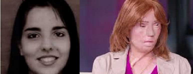 Historia Jacqueline Saburido y el accidente que cambio su vida